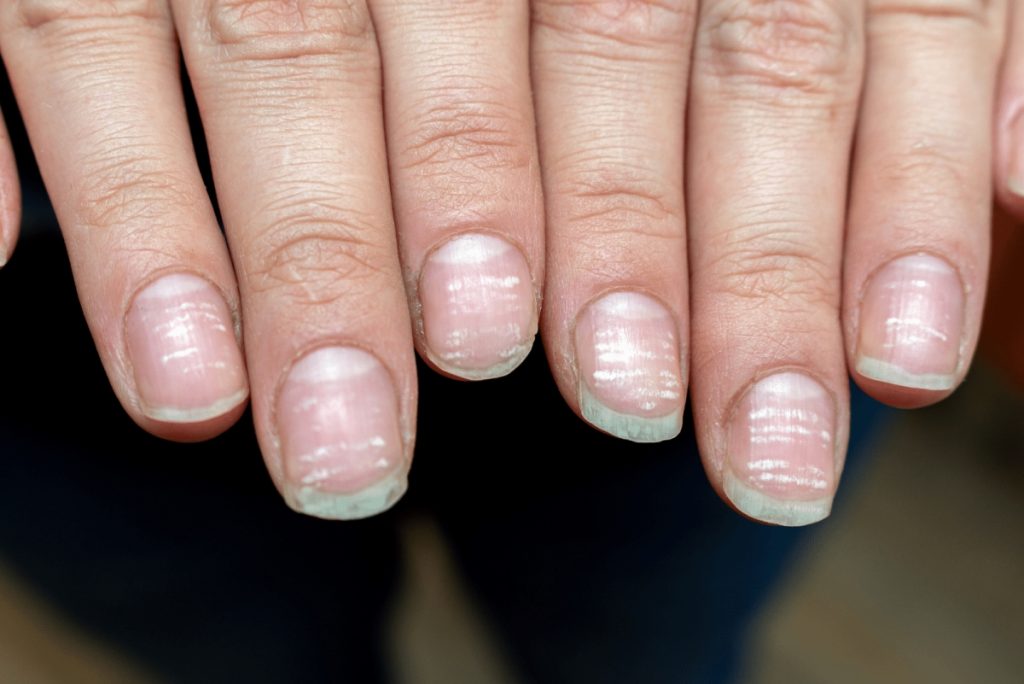 nails sign of hormone imbalance 