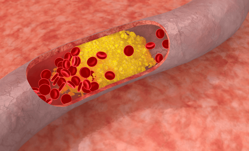 What Causes High Cholesterol and Does It Really Cause Heart Disease?