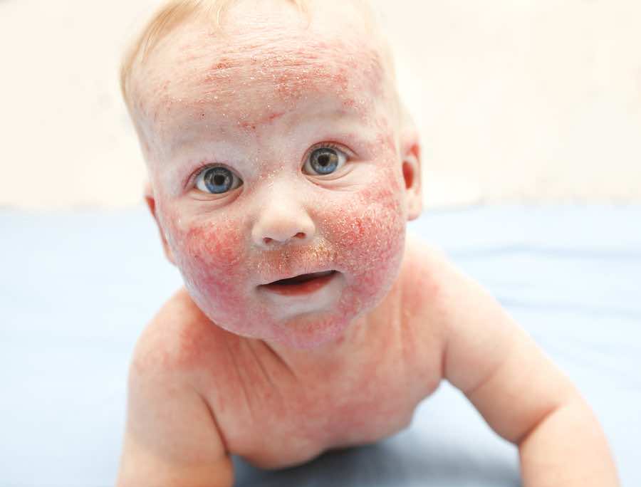 Little baby with dermatitis on face – BiOptimizers